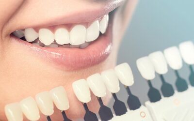 Quais planos odontológicos cobrem facetas?