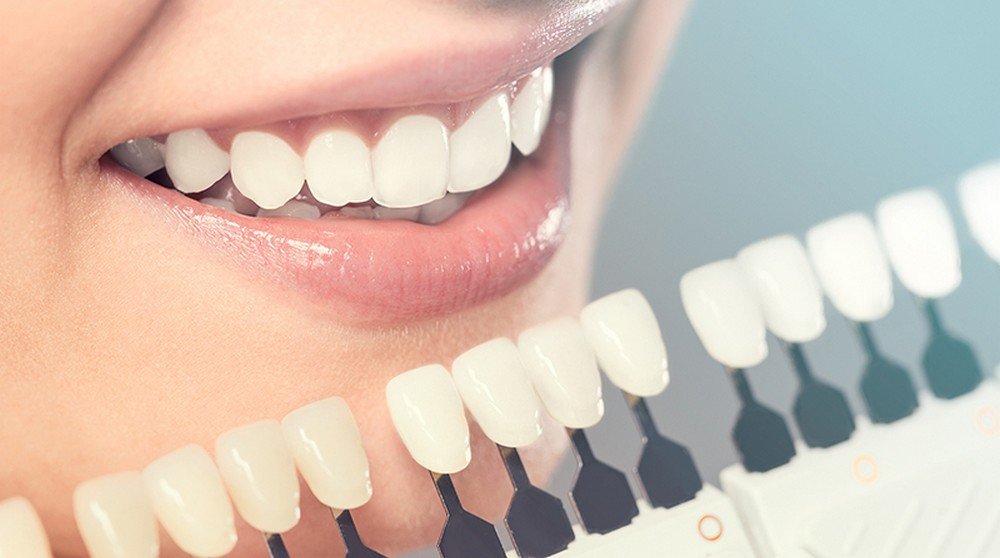 planos-odontológicos-que-cobrem-facetas