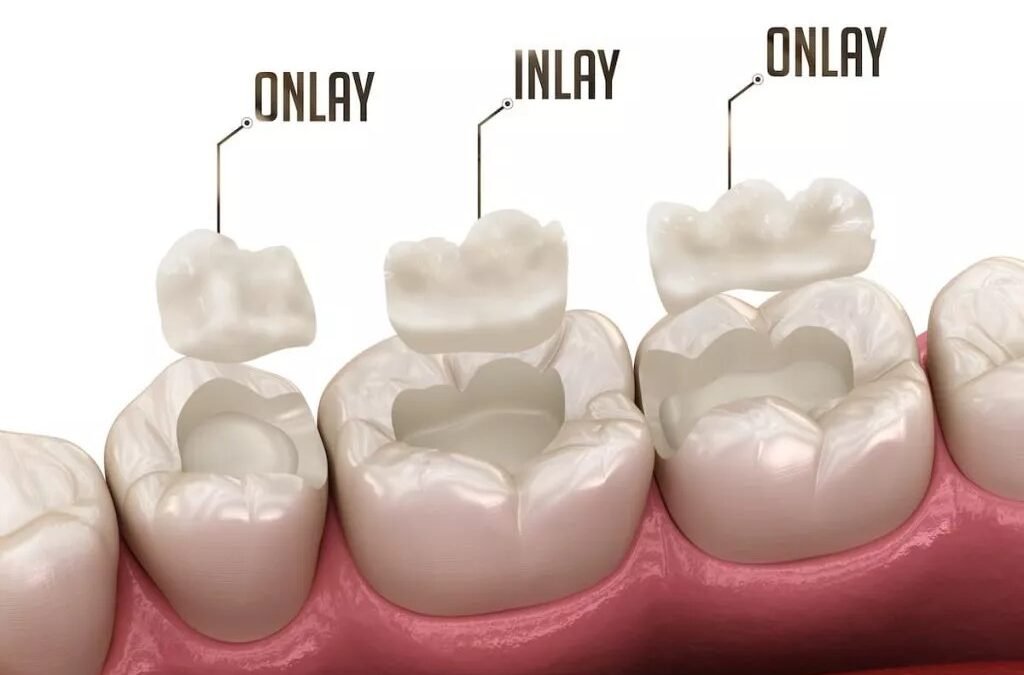 20 benefícios da restauração, obturação ou bloco Inlay e Onlay para seus dentes