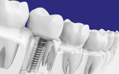 Os 15 Benefícios do Implante Dentário e Prótese Protocolo: Um Guia Completo