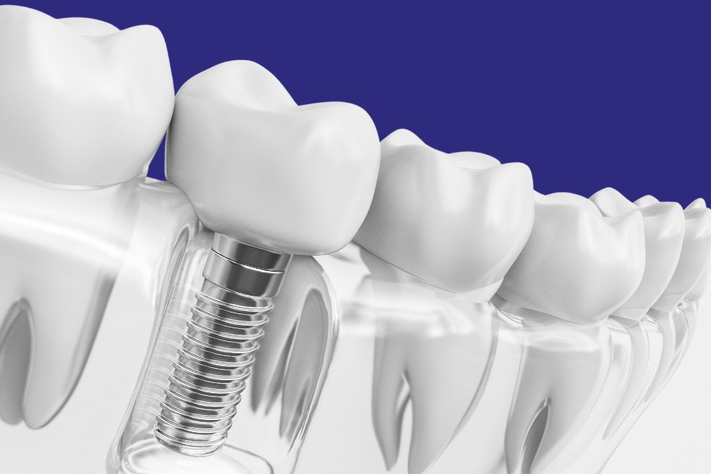 Os 15 Benefícios do Implante Dentário e Prótese Protocolo: Um Guia Completo