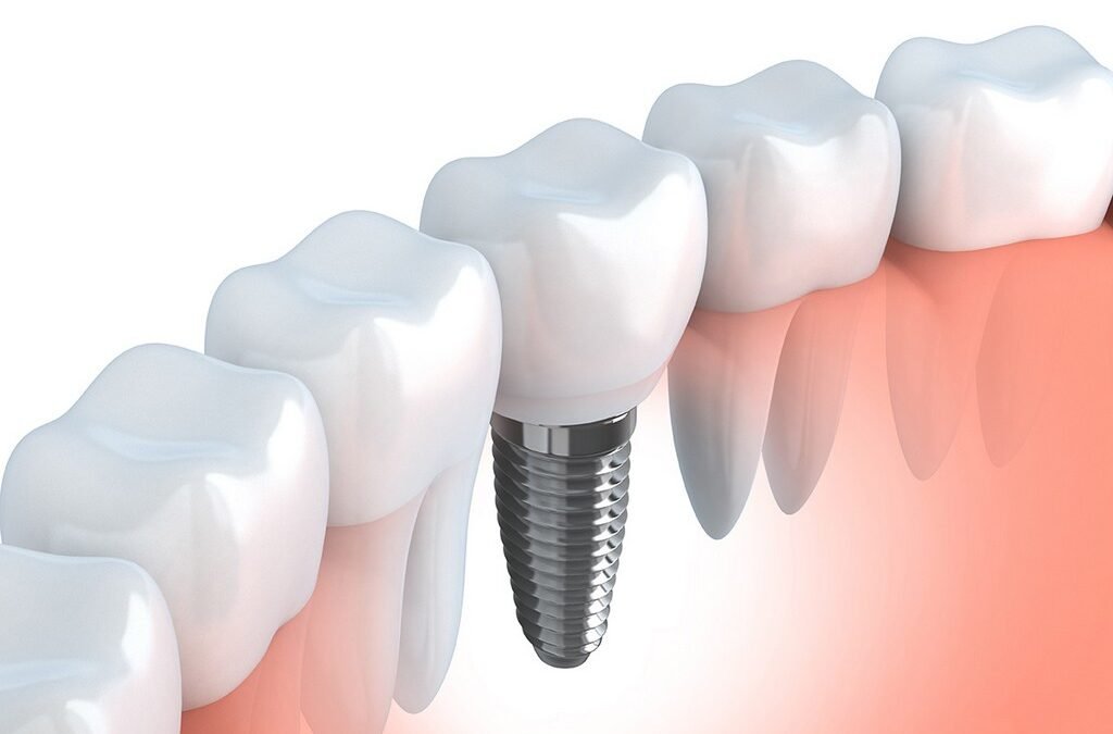 Benefícios de contratar plano odontológico com implantes para sua empresa