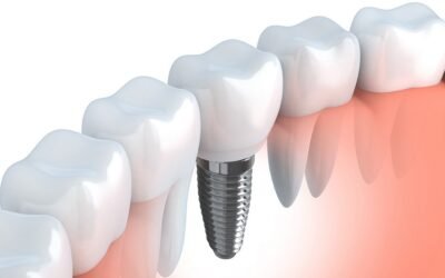 Benefícios de contratar plano odontológico com implantes para sua empresa