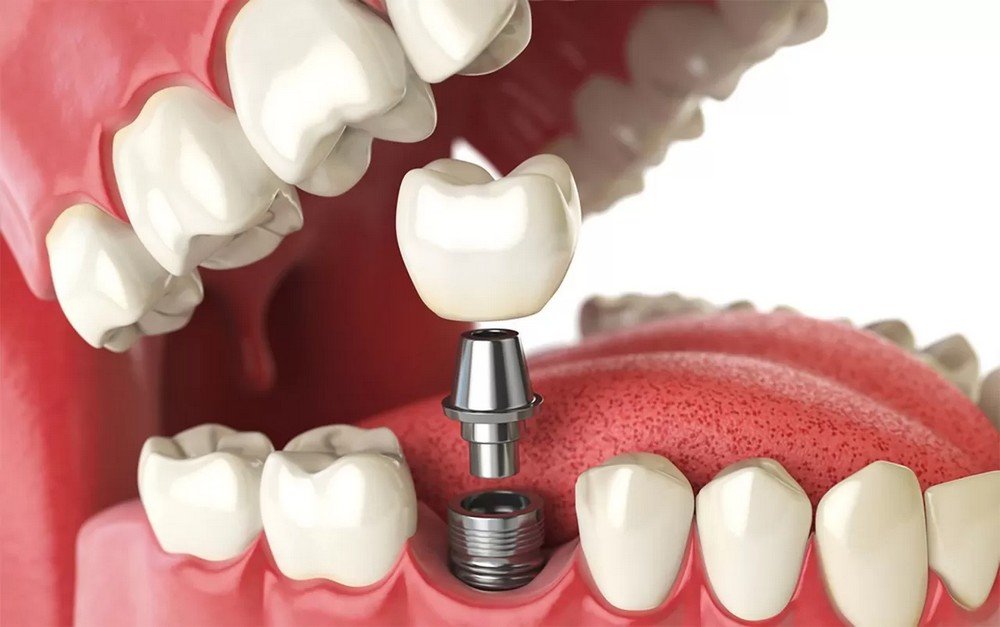 Amil-Dental-cobre-implantes-a-partir-de-4-vidas