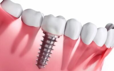 Descubra Quanto Custa um Implante Dentário e as Vantagens do Plano com Implantes