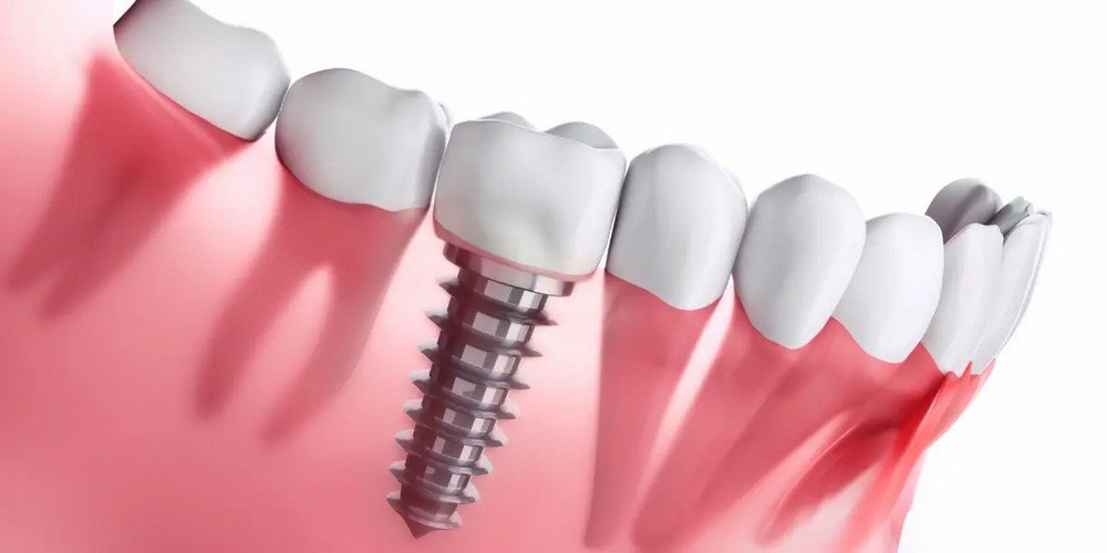 Descubra-Quanto-Custa-um-Implante-Dentário-e-Vantagens-do-Plano-Implantes